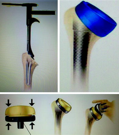 The Biomet Comprehensive© Reverse Total Shoulder System Design ...