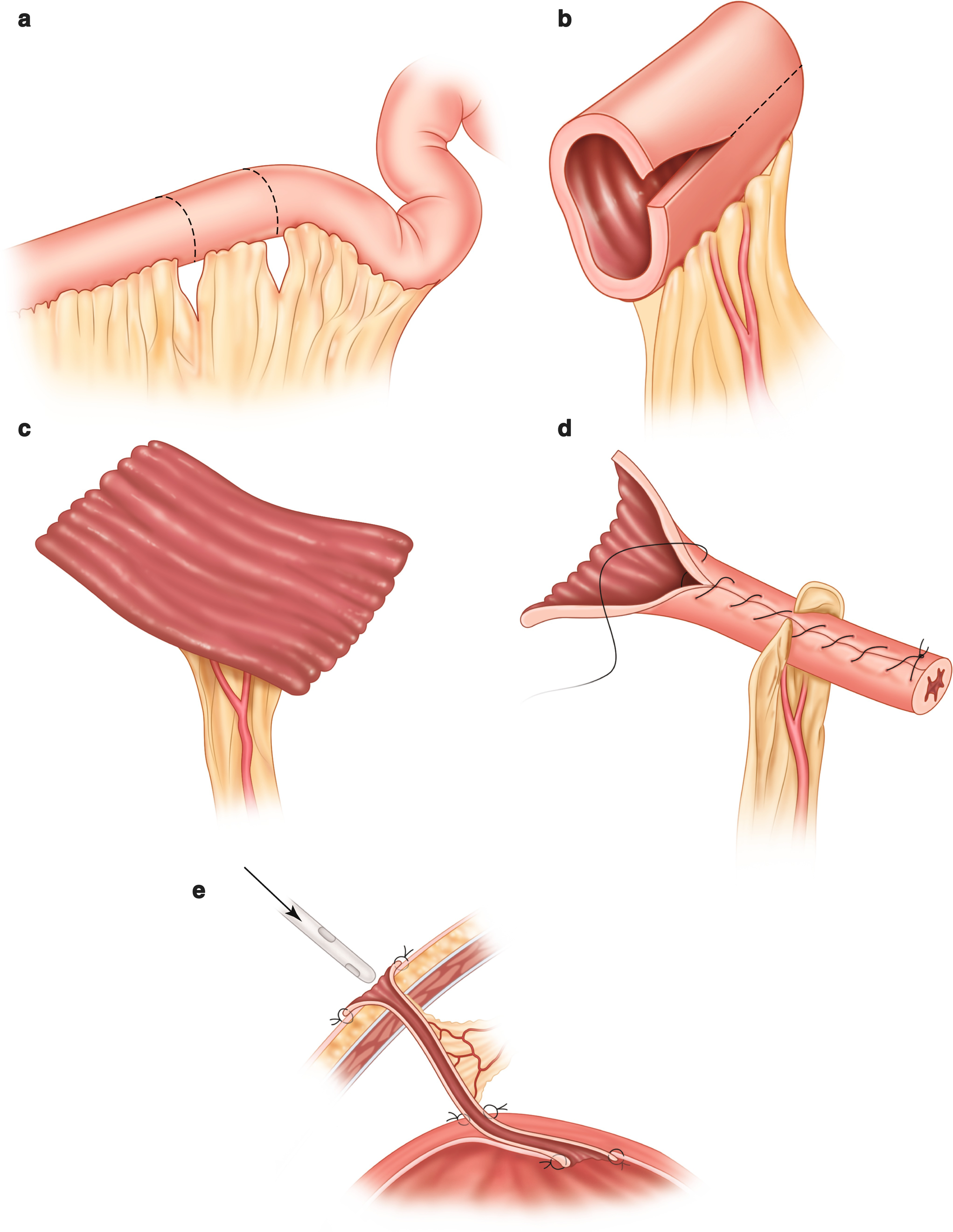 Intestinal Stomas SpringerLink