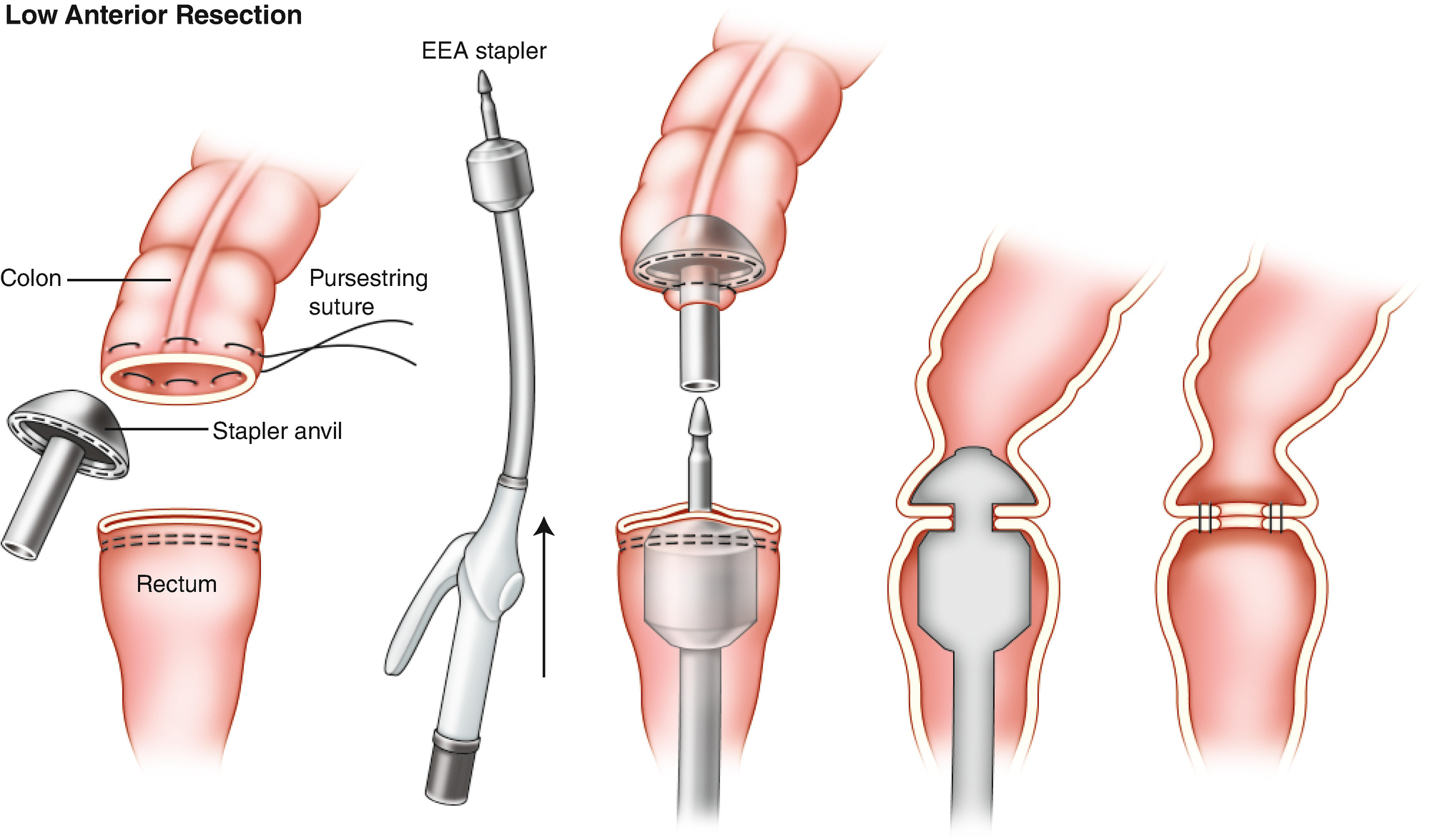 anastomotic anastomosis colorectal double figure stapled construction techniques