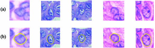 Automated Nuclear Pleomorphism Scoring in Breast Cancer Histopathology ...