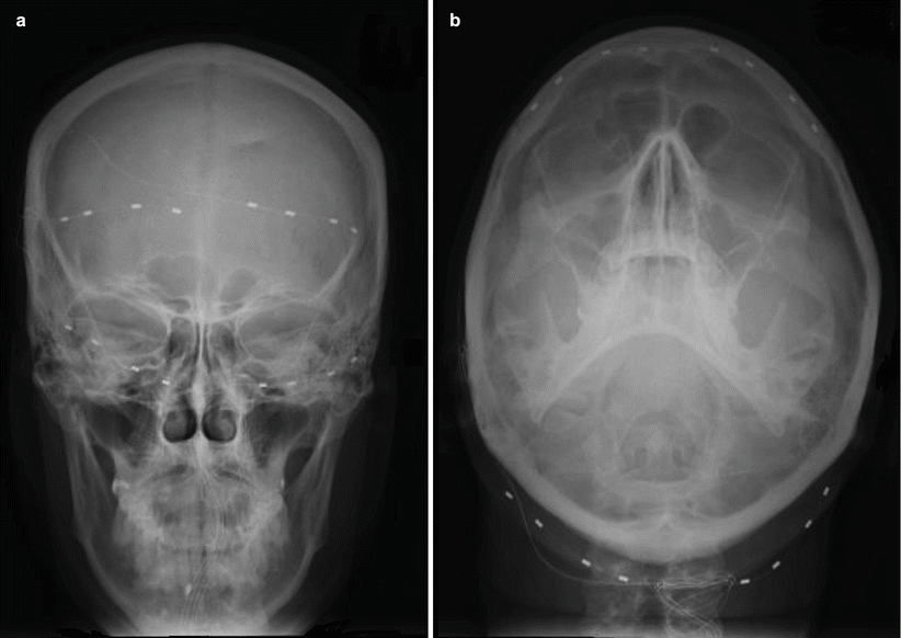 Supraorbital Nerve Entrapment: Face | SpringerLink