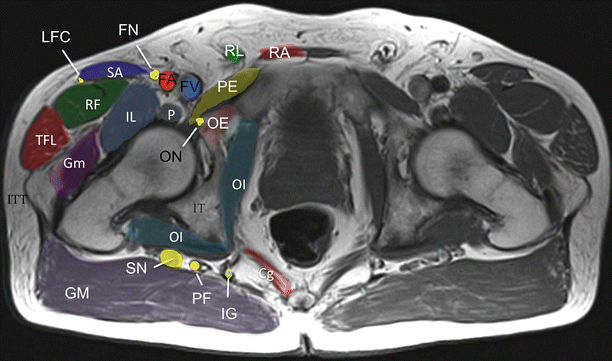 Posterior Femoral Cutaneous Nerve Entrapment Low Back