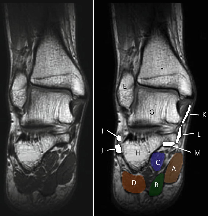 Lateral Plantar Nerve Entrapment SpringerLink