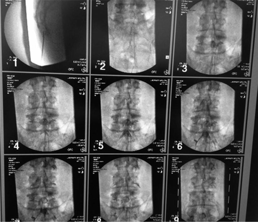 Introduction to Lysis of Adhesions SpringerLink