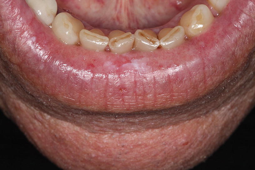 Oral Mucosal Malignancies Springerlink