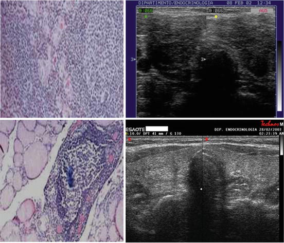 Hashimoto’s Thyroiditis | SpringerLink