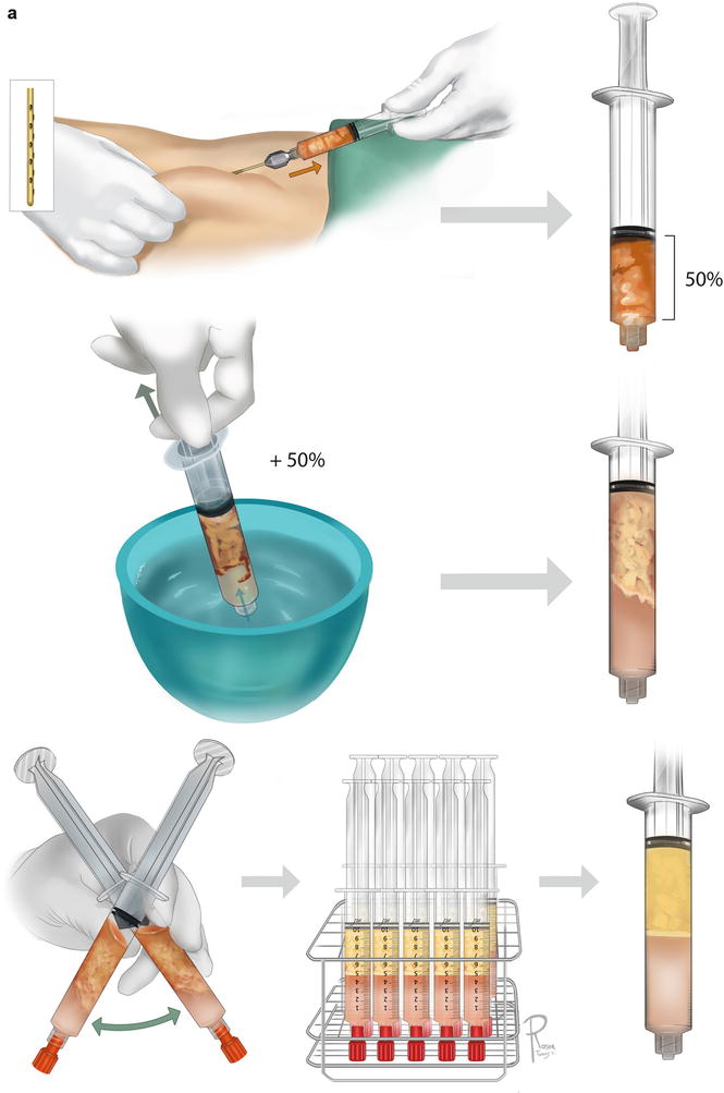 A Howto Guide on Structural Fat Grafting, Microfat Grafting, SharpNeedle Intradermal Fat