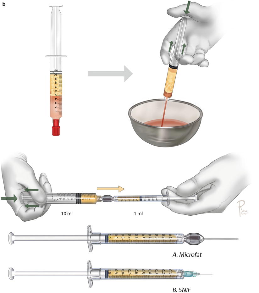 A Howto Guide on Structural Fat Grafting, Microfat Grafting, SharpNeedle Intradermal Fat