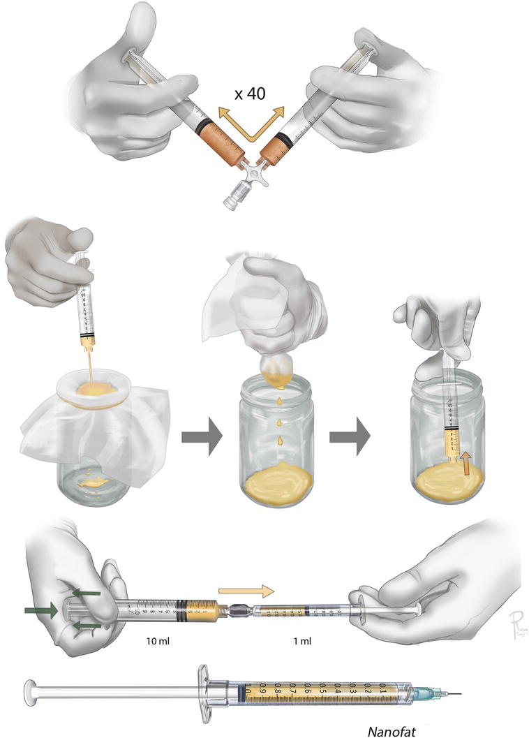 A Howto Guide on Structural Fat Grafting, Microfat Grafting, SharpNeedle Intradermal Fat