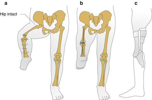 Limb and Back Reduction Deficiency Present at Birth | SpringerLink