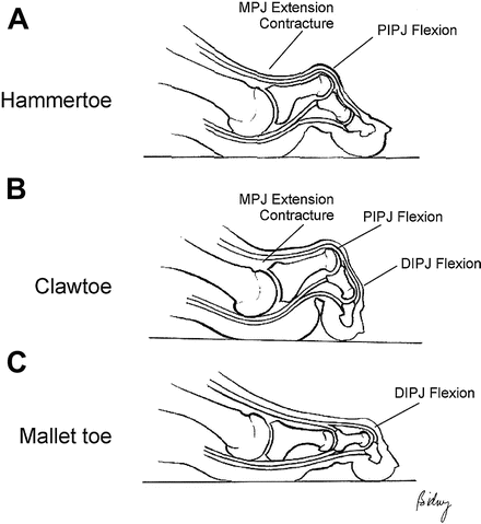 Hammer Toe Deformity | SpringerLink