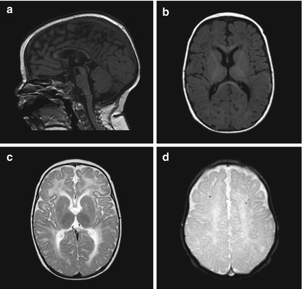 Radiological Differential Diagnosis of Microcephaly | SpringerLink