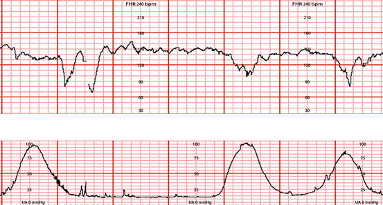 Fetal Heart Rate Monitoring SpringerLink
