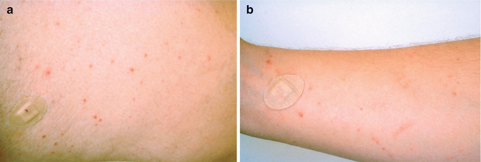 Metal Allergy Beryllium SpringerLink
