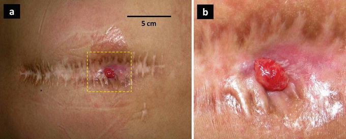 Surgical Site Infections in Spinal Surgery SpringerLink
