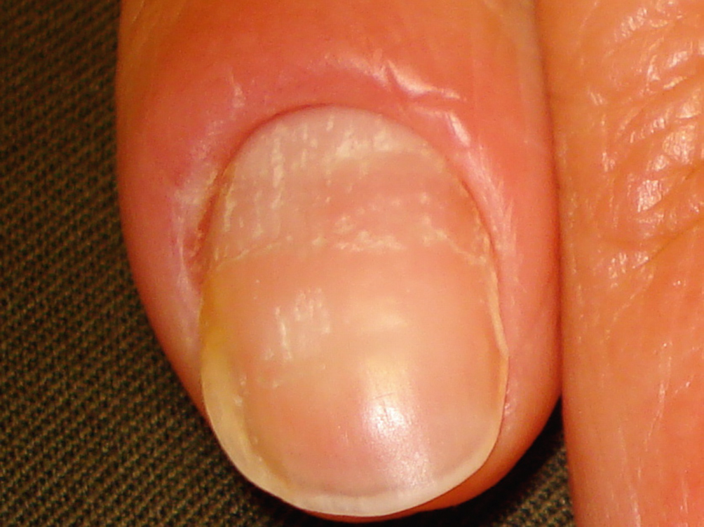 Pterygium Nail Symptoms Nail Ftempo