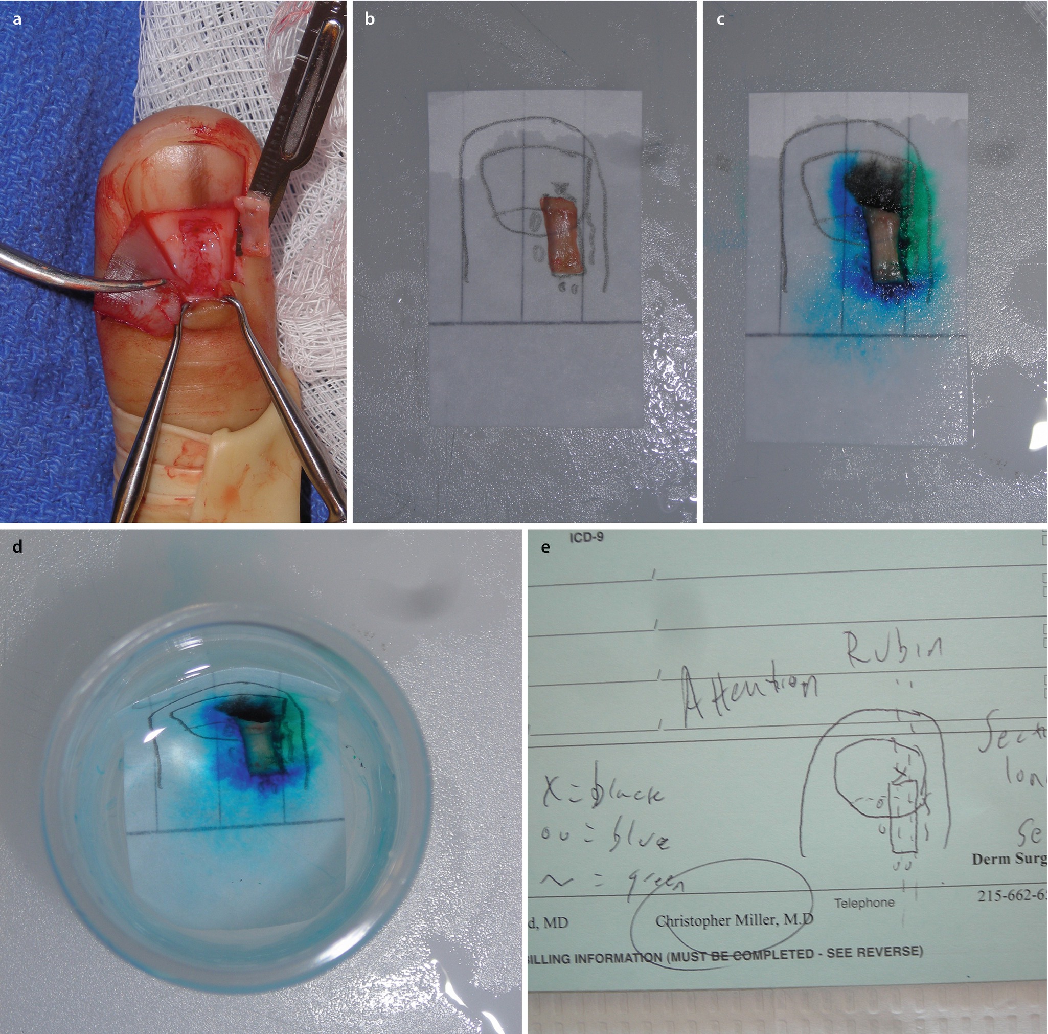 Avulsion Great Toenail Icd 9 Nail Ftempo