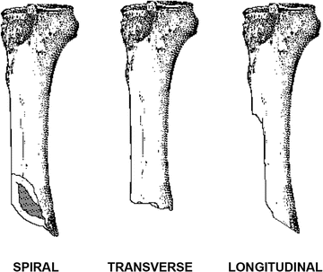 Human, Animal, Geological Causes of Bone Breakage | SpringerLink