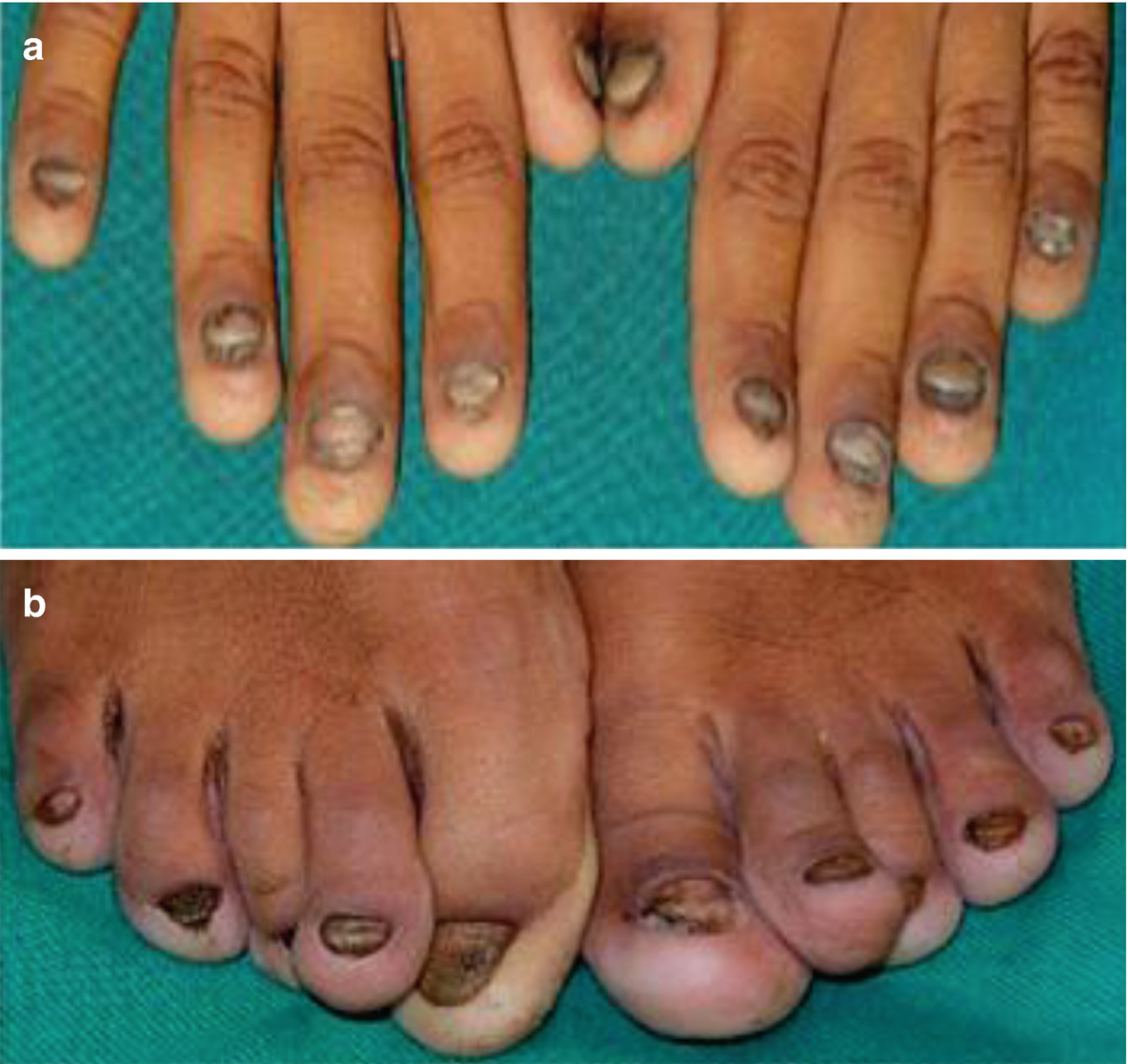 Ciclopirox Gel 0 77 Toenail Fungus Nail Ftempo