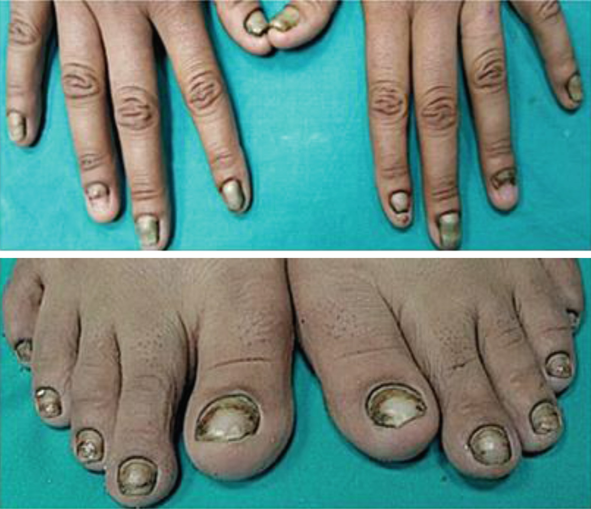 Ciclopirox Gel 0 77 Toenail Fungus Nail Ftempo