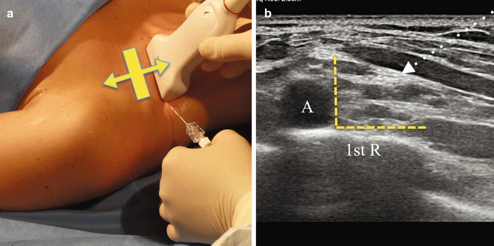 USGuided Nerve Blocks Procedure Technique SpringerLink