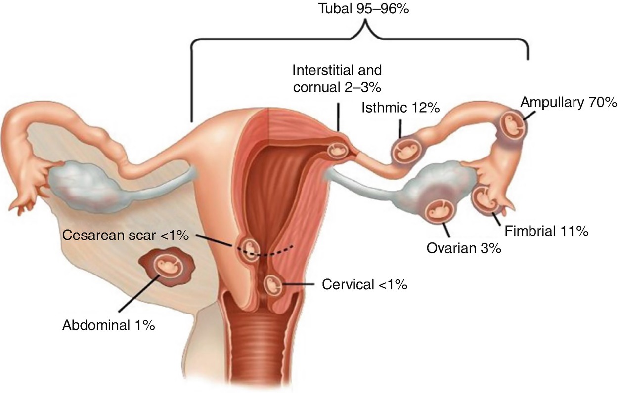 Download Adnexal Cyst When To Worry Pics