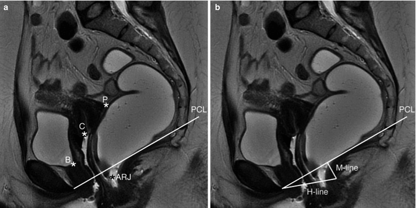MRI of the Pelvic Floor and MR Defecography | SpringerLink