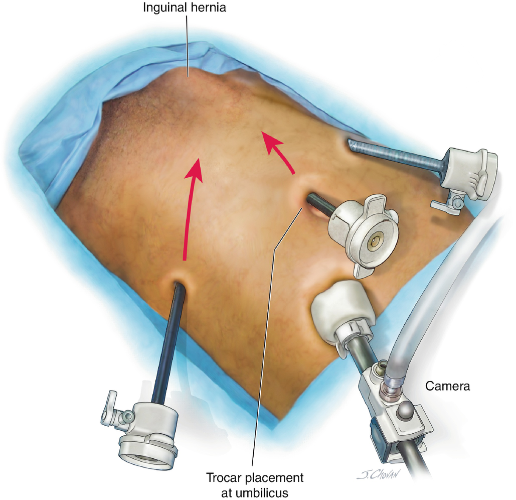Minimally Invasive Surgical Techniques for Inguinal Hernia Repair: The ...