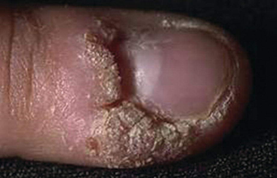 Can Warts Grow Under Nails Nail Ftempo