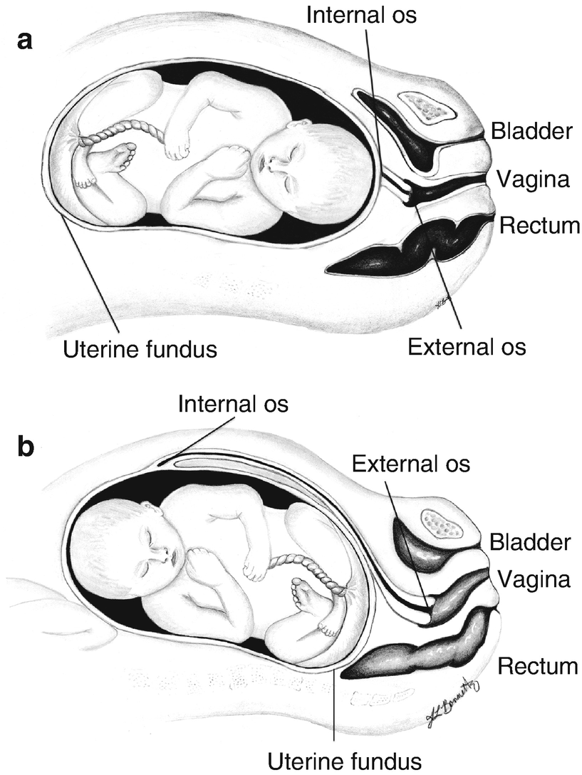 K Retroversion Of Uterus - maternity photos