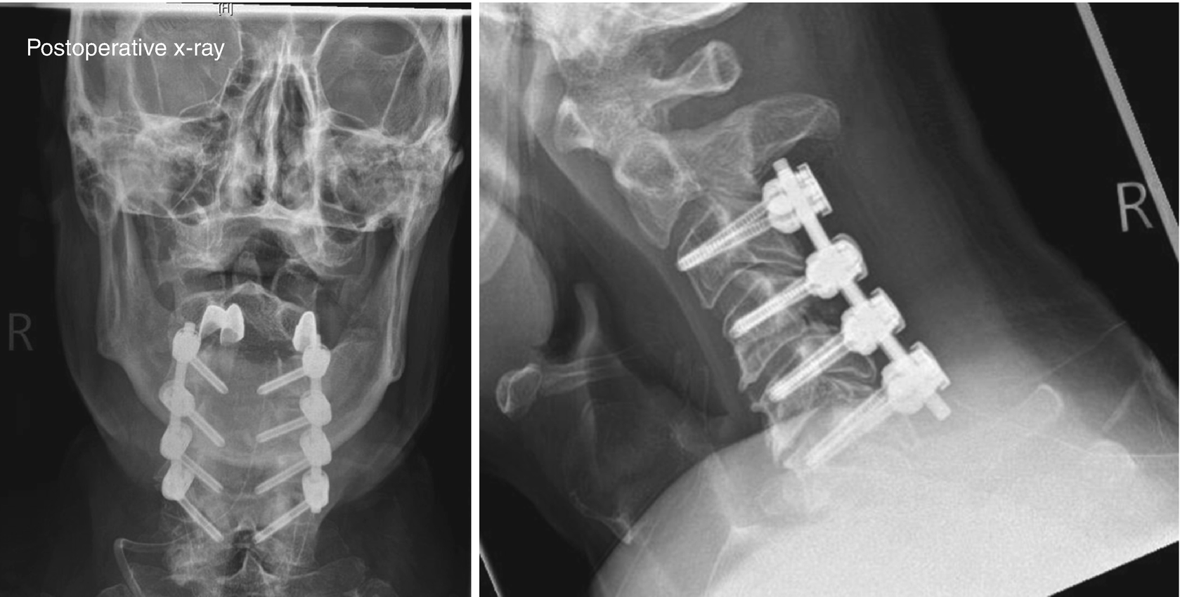 Cervical Myelopathy Indication and Operative Procedure SpringerLink