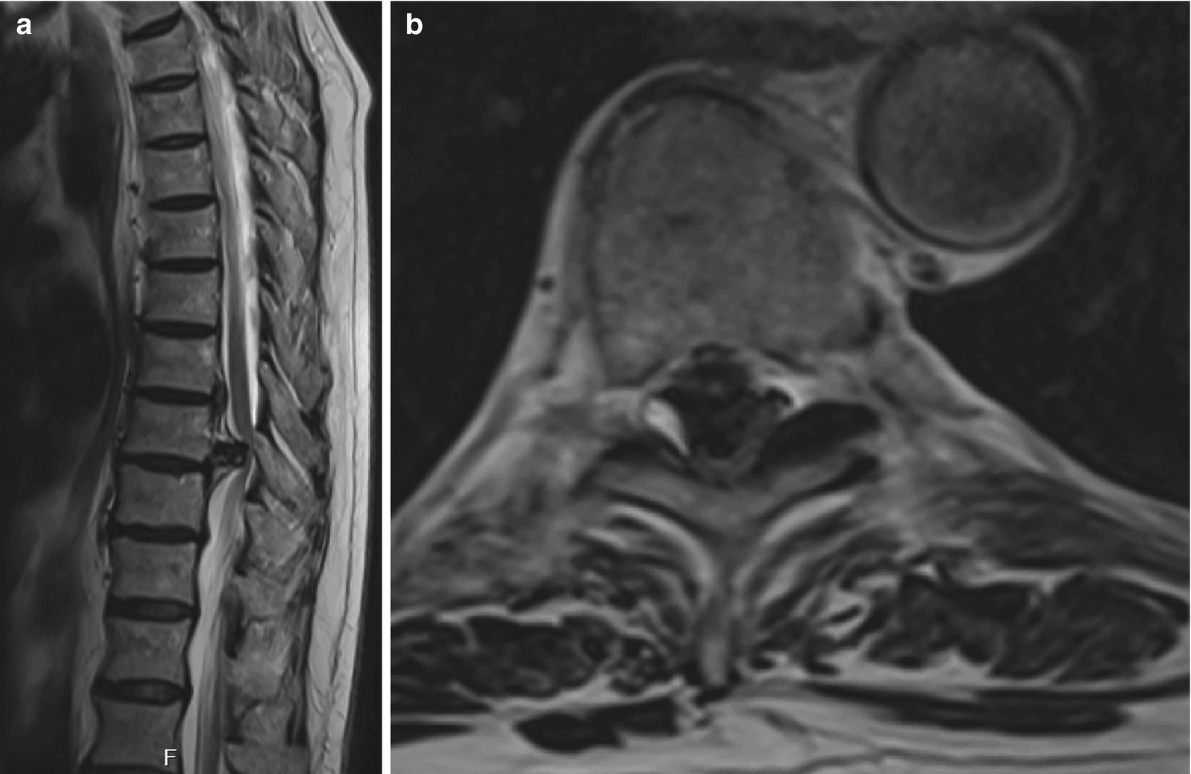 Thoracic Disc Herniation and Myelopathy SpringerLink
