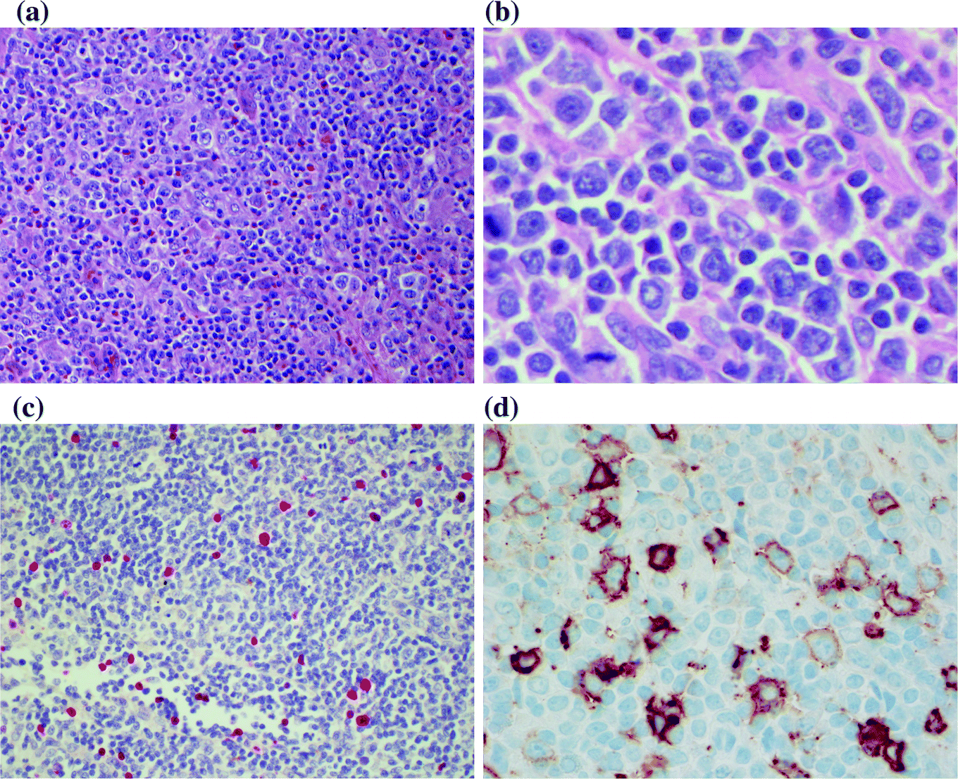Angioimmunoblastic T Cell Lymphoma Cd10 Expression In
