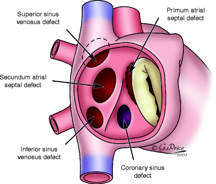Atrial Septal Defect | SpringerLink
Sinus Venosus Asd
