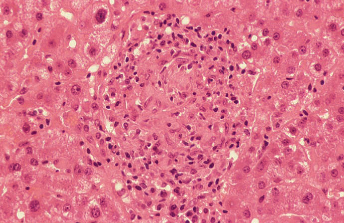 What Is A Granuloma - slideshare