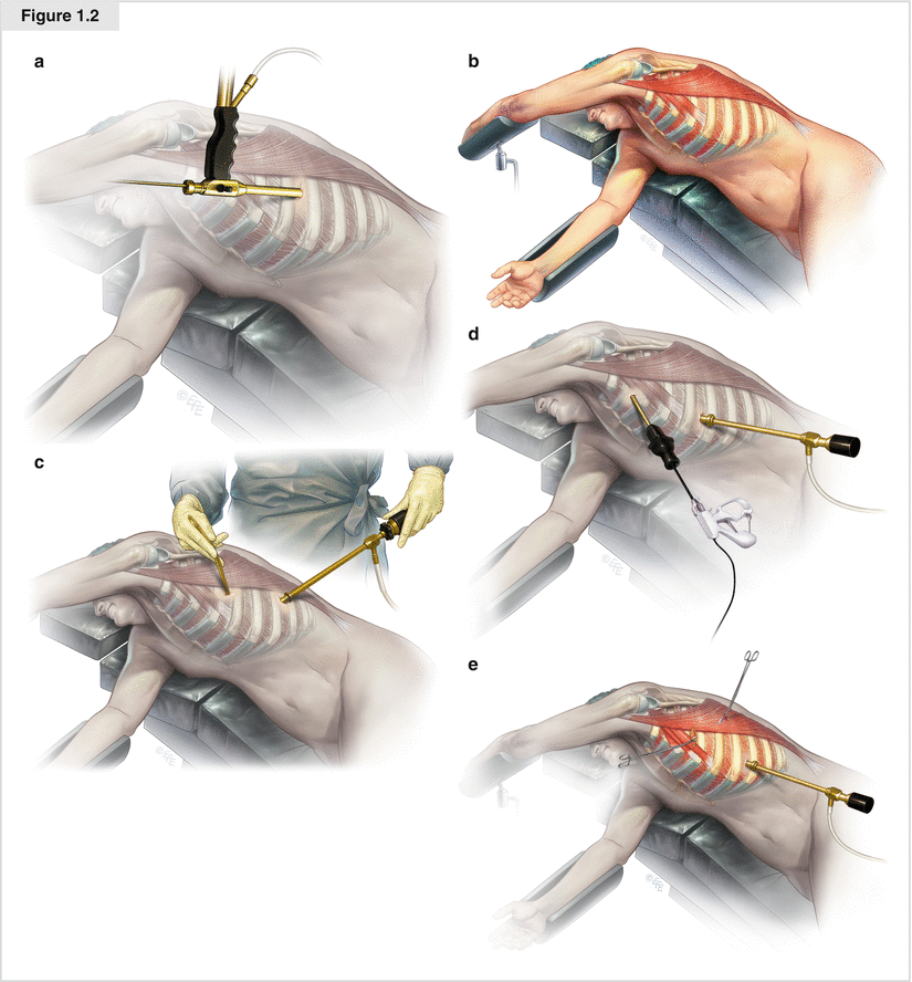 VideoAssisted Thoracoscopic Surgery SpringerLink