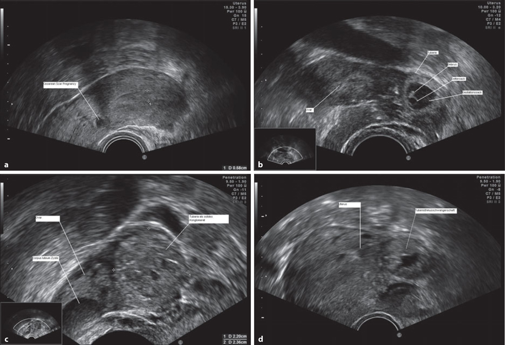 Extrauteringravidität SpringerLink