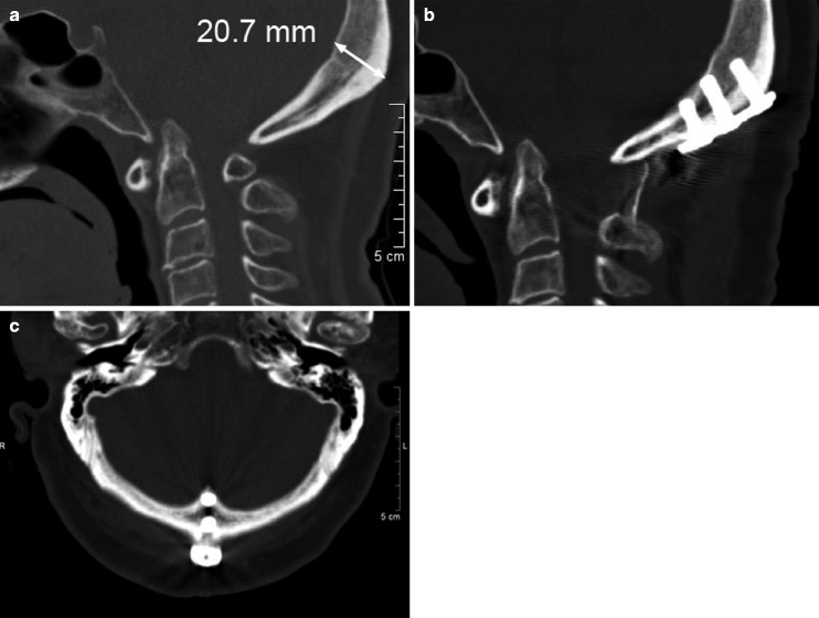 Specific Reconstruction Techniques Of Upper Cervical Spine