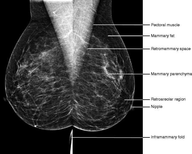 Mammography Anatomy Of Breast _ Stereotactic and Needle Breast Biopsy ...
