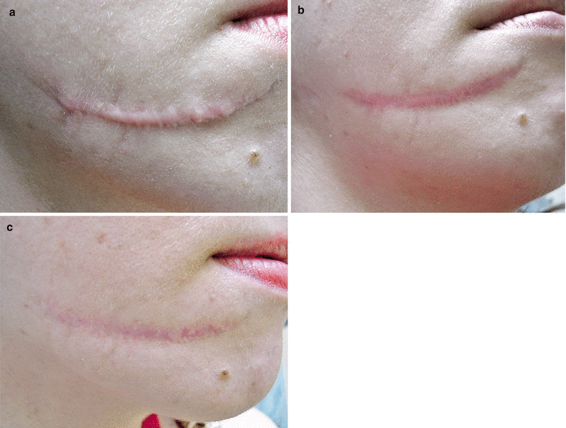 Pathological Scars (Keloid and Hypertrophic Scars) SpringerLink