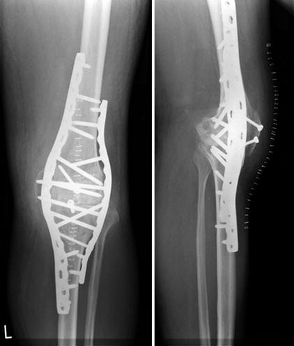 Knee Arthrodesis | SpringerLink