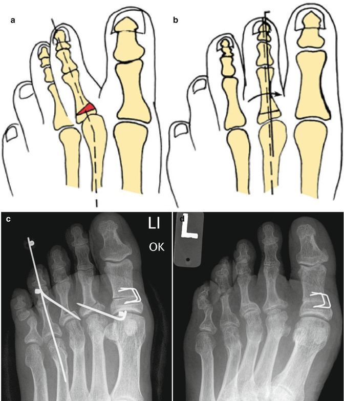 Lesser Toe Deformities SpringerLink