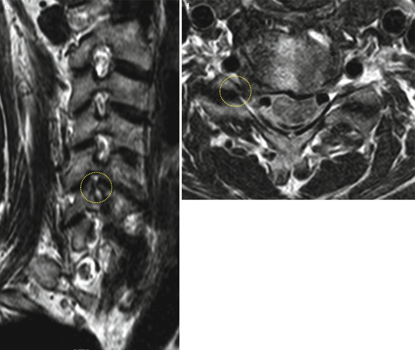 Common Spine Disorders Associated with Neck Pain | SpringerLink