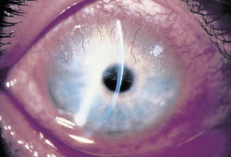 Pannus/Micropannus | SpringerLink