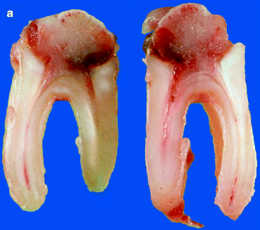 Disorders of the Dental Pulp | SpringerLink