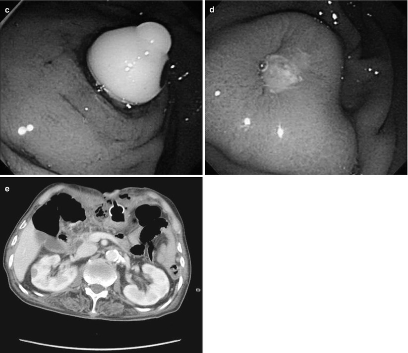 Percutaneous Endoscopic Gastrostomy SpringerLink
