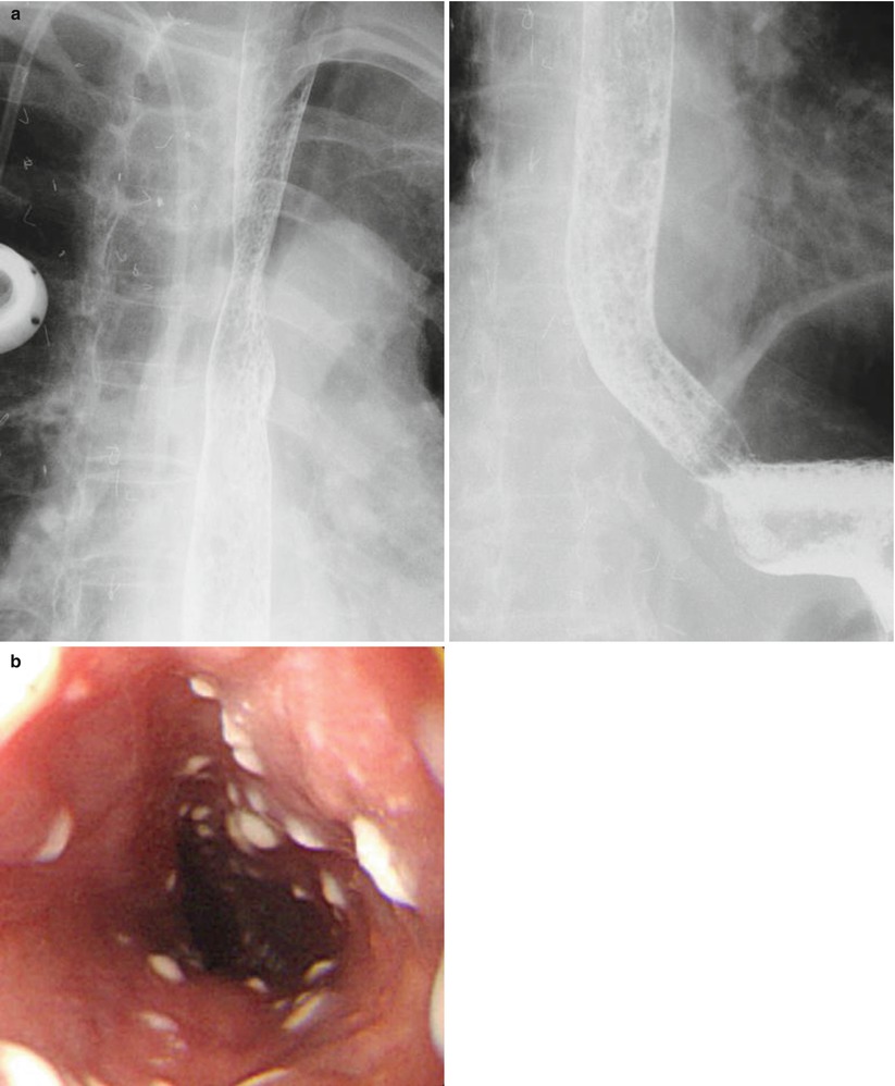 Esophagitis | SpringerLink