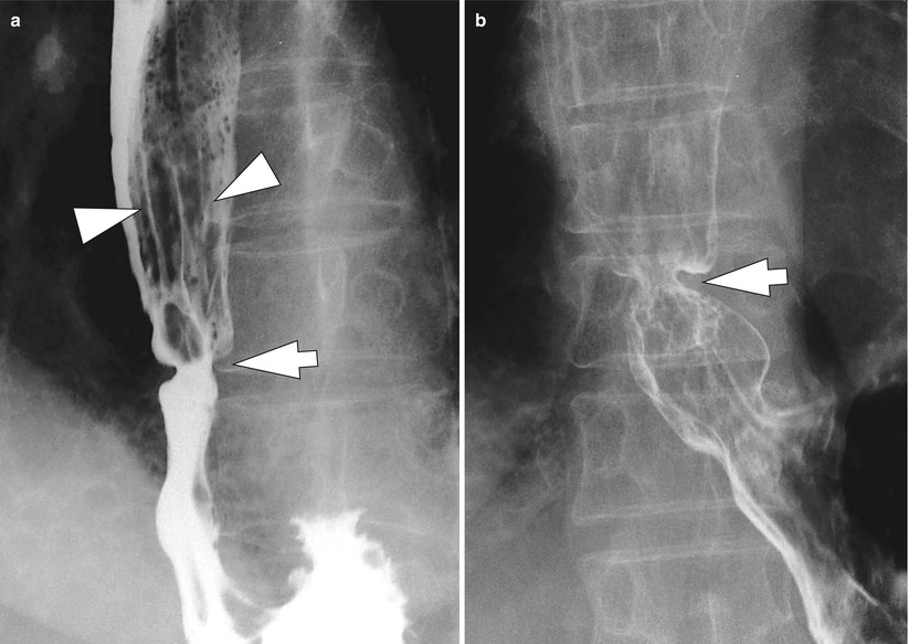 Esophagitis SpringerLink