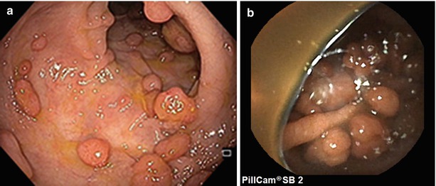 Familial Adenomatous Polyposis | SpringerLink