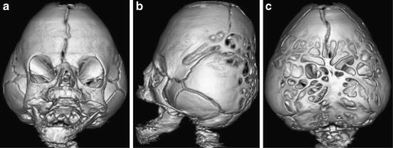 Craniosynostoses | SpringerLink